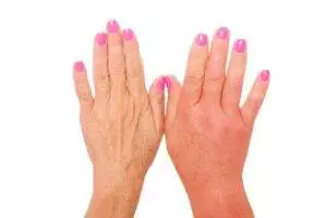 Two hands with pink nail polish against white background; Inflammation showing on one hand.